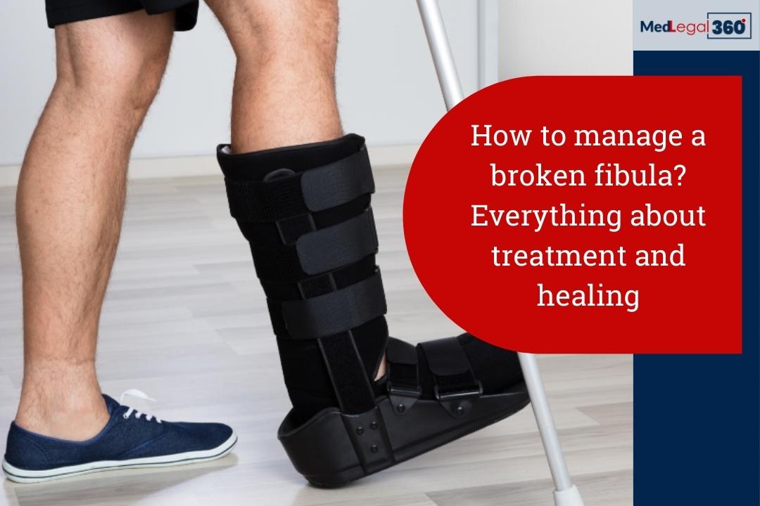 How to manage a broken fibula? Everything about treatment and healing