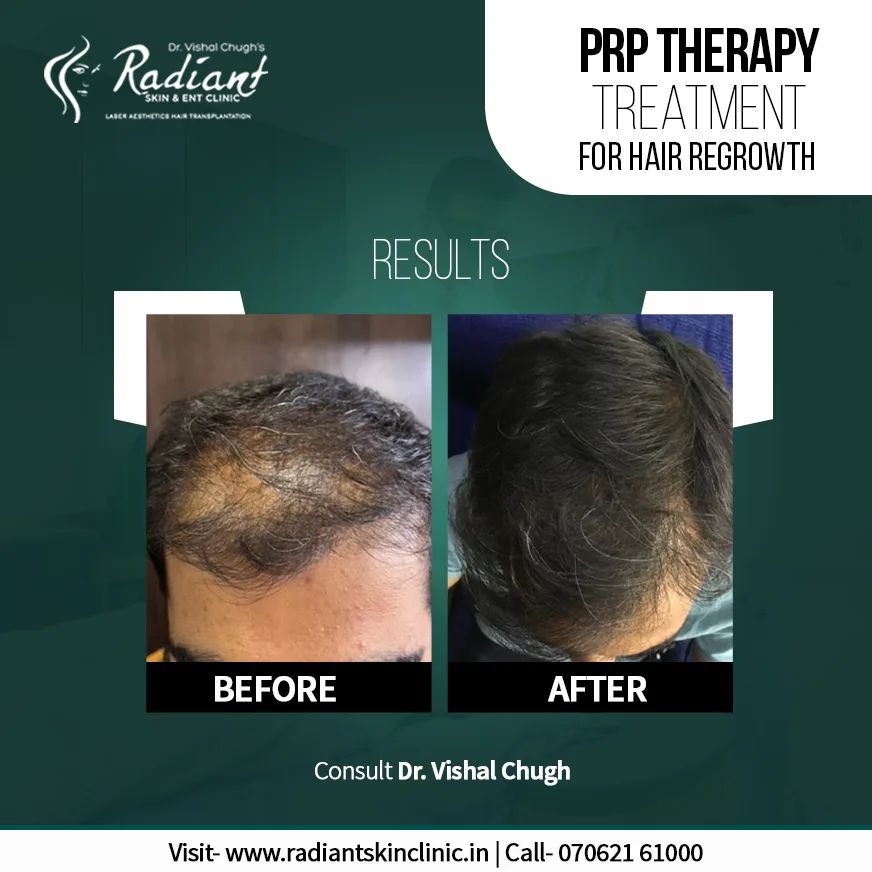 Hair Treatment Clinic | Best Hair Treatment in Jaipur