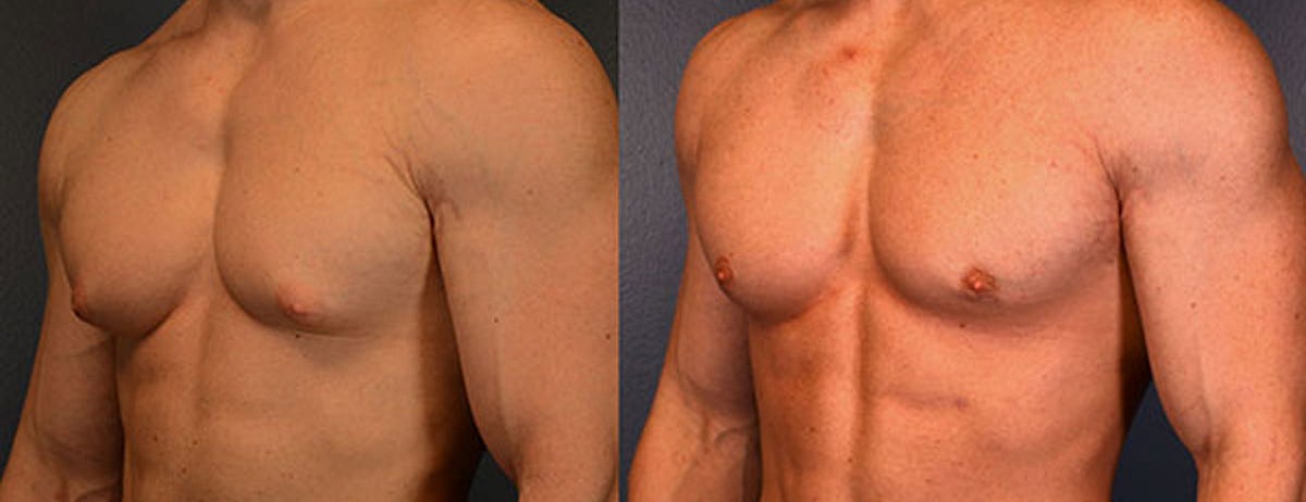 What do you need to know before undergoing gynecomastia surgery? | by Surgiderma | Mar, 2024 | Medium