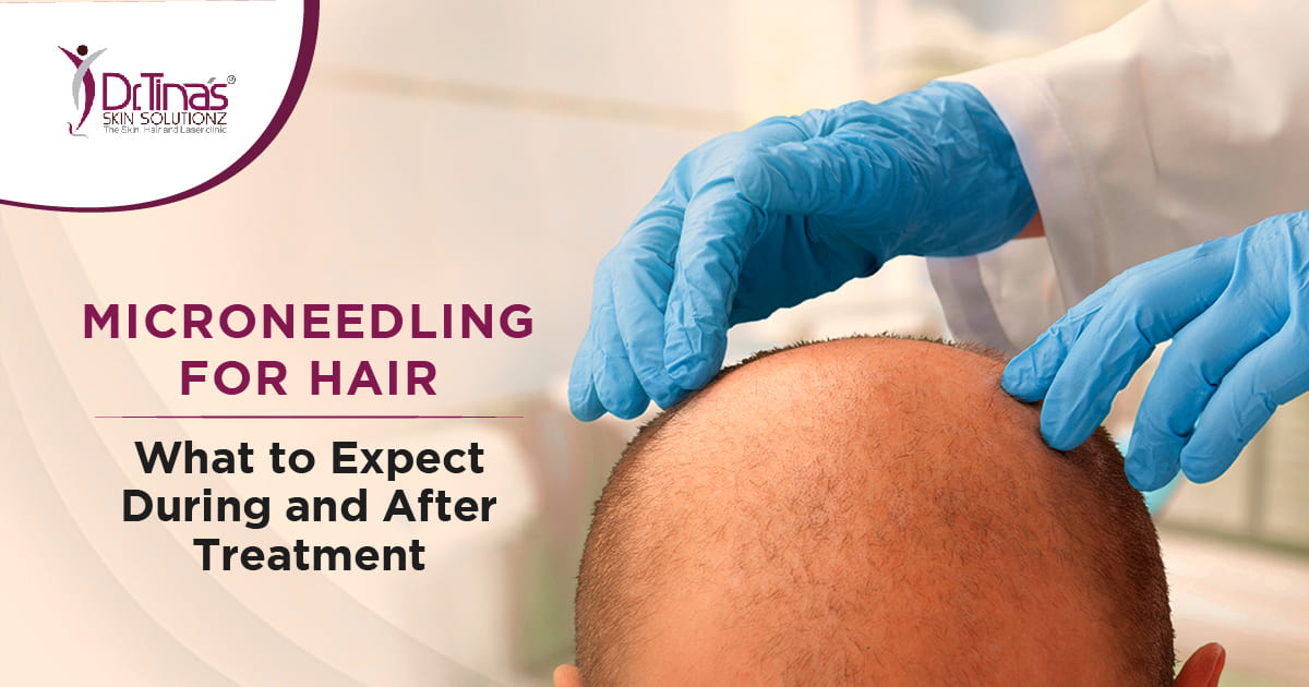 Microneedling for Hair: What to Expect During and After Treatment  - Skin Solutionz