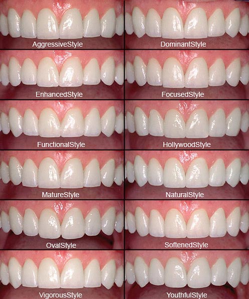 Porcelain Veneers specialist in Castle Hills, Lewisville & Dallas TX