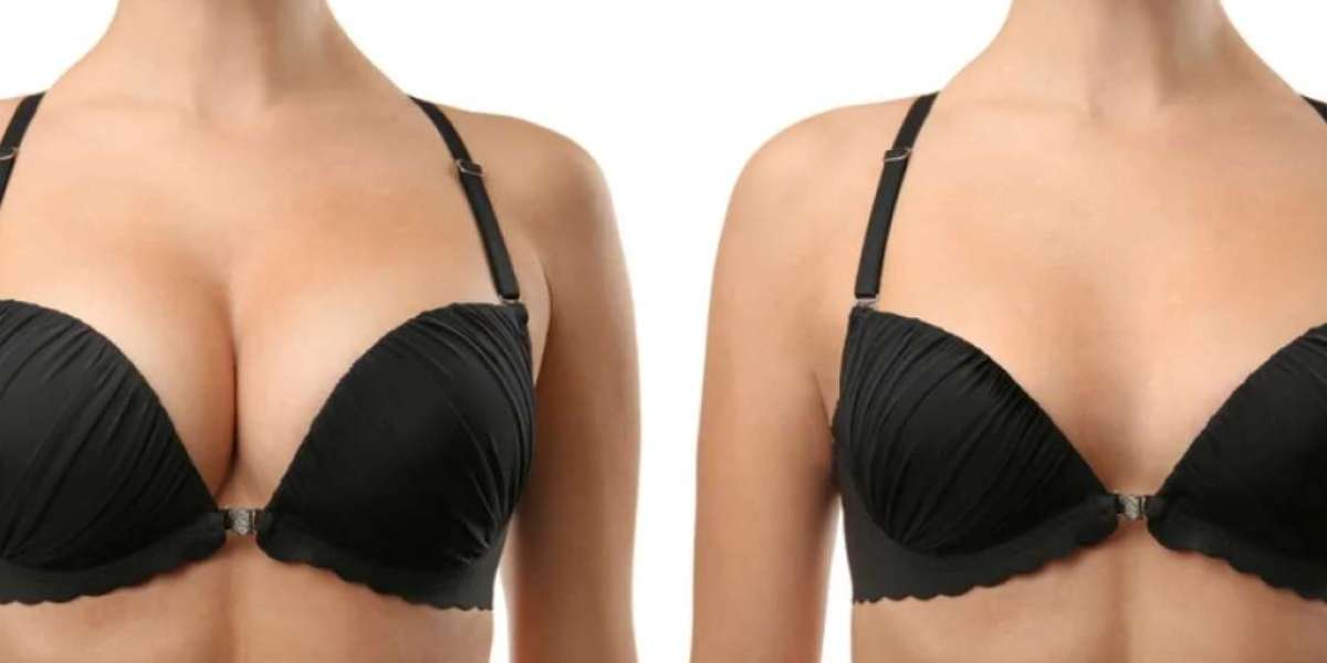 Top Breast Reduction Surgery Pune - Dr. Shilpy Dolas