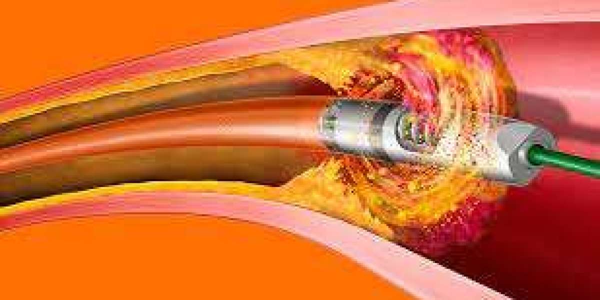 Atherectomy Devices Market will be US$ 2,028.3 Million by 2032