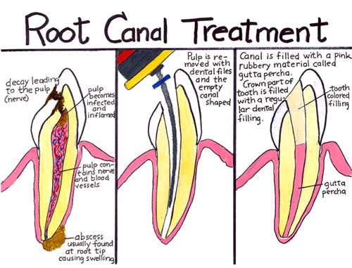 Root C**** Therapy Lewisville TX - The Colony, Texas Root C**** Therapy - D. Dental