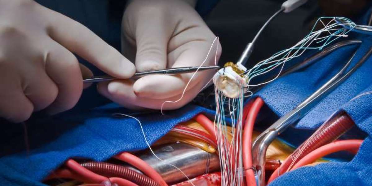 Transcatheter Heart Valve Replacement Market And Global Forecast Report 2024-2032