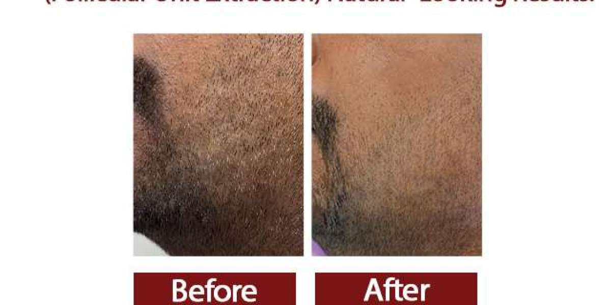 FUE Grey Beard Treatment at AWISH Clinic | Restore Your Beard Naturally