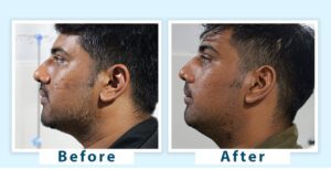 Best Grey Beard Treatment in Delhi NCR | White Beard Solutions- AWISH CLINIC