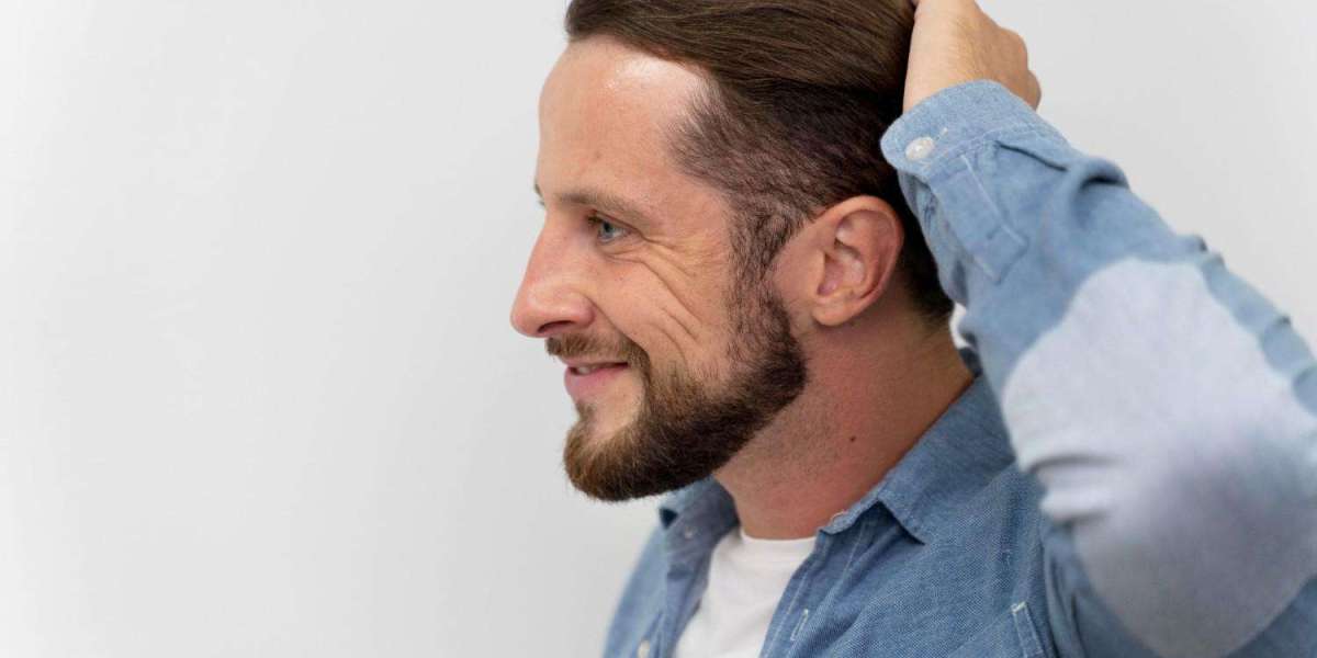 Hair Transplant: A Confidence Booster