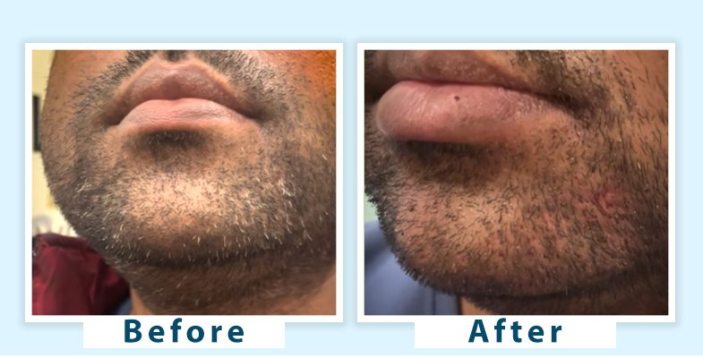 Premature Grey Beard Removal | Grey Beard Treatment in Delhi