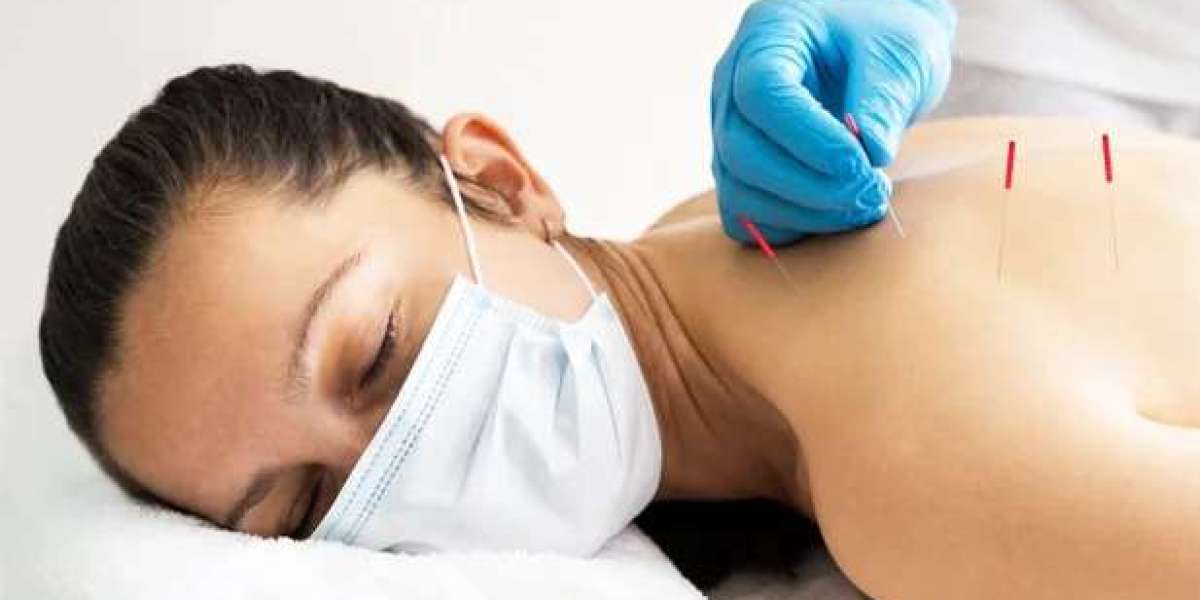 Discover the Healing Power of Dry Needling in Surrey