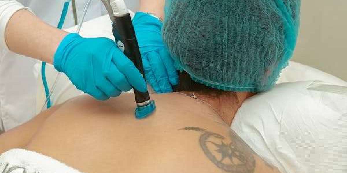 Erase the Past with Confidence: Discover Laser Tattoo Removal Near Henderson, NV at Mila Aesthetics